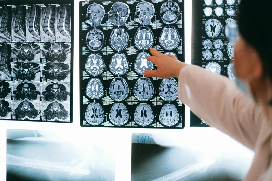 Doctor analyzing brain MRI scans on a lightbox